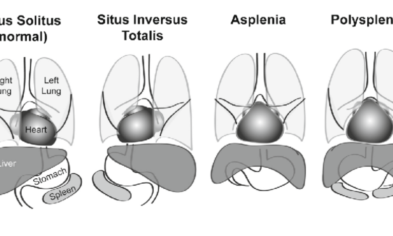 Situs İnversus Nedir